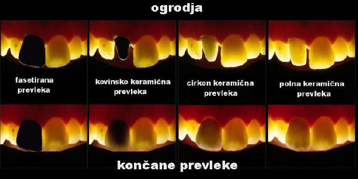 Prosevnost svetlobe pri porcelanski prevleki.